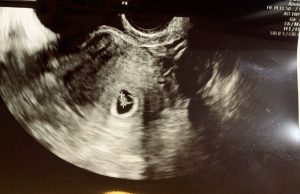 初期 子宮 内出血 妊娠